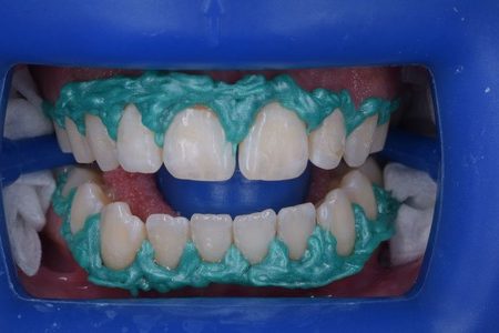 Fig. 5: Se hidrataron los labios del paciente para la colocación del retractor labial. Luego con las encías secas, se aplicó la barrera gingival Top dam. Nos aseguramos de que no hubiera sangre en la superficie gingival para lograr una mejor unión del dique.