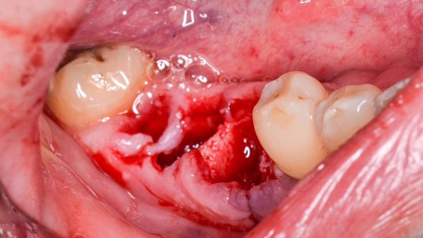 Alveolos apos a - Manutenção óssea alveolar com Nanosynt e implantes dentários hexágono externo Vezza HE