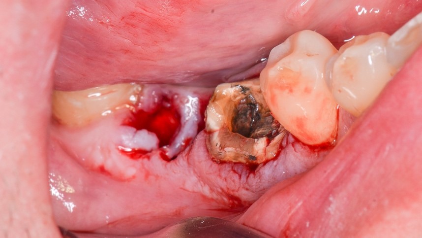 Condicao clinica inicial - Manutenção óssea alveolar com Nanosynt e implantes dentários hexágono externo Vezza HE