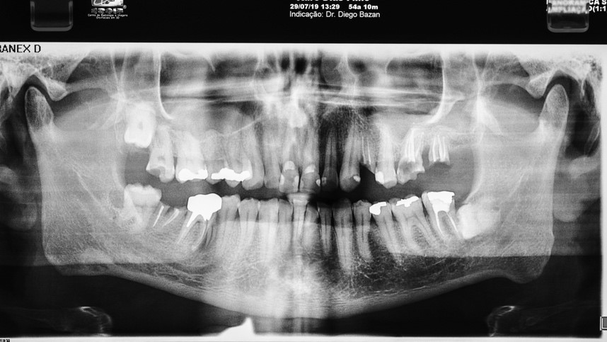 Exame radiografico inicial - Manutenção óssea alveolar com Nanosynt e implantes dentários hexágono externo Vezza HE