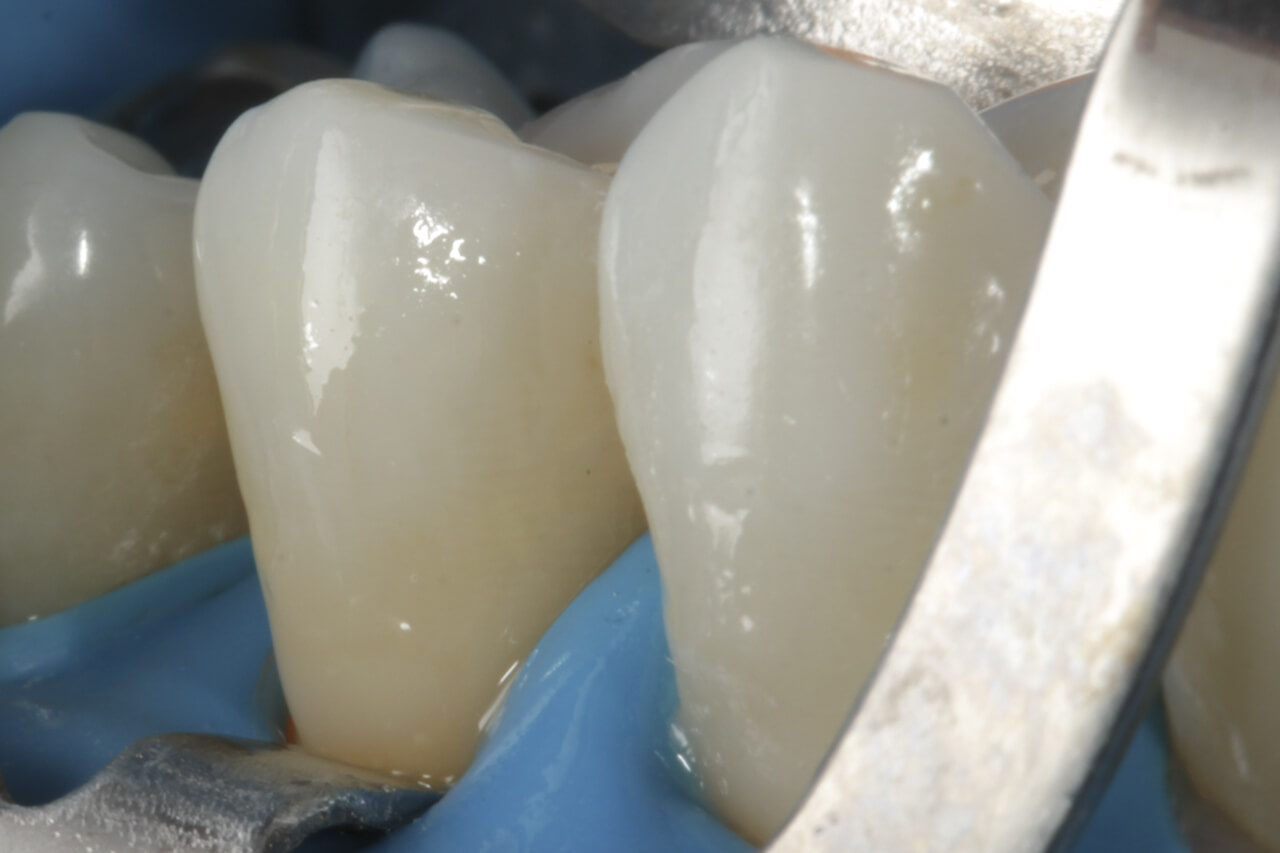 Fig. 12 Aspecto inmediato de la restauración en el diente 25.