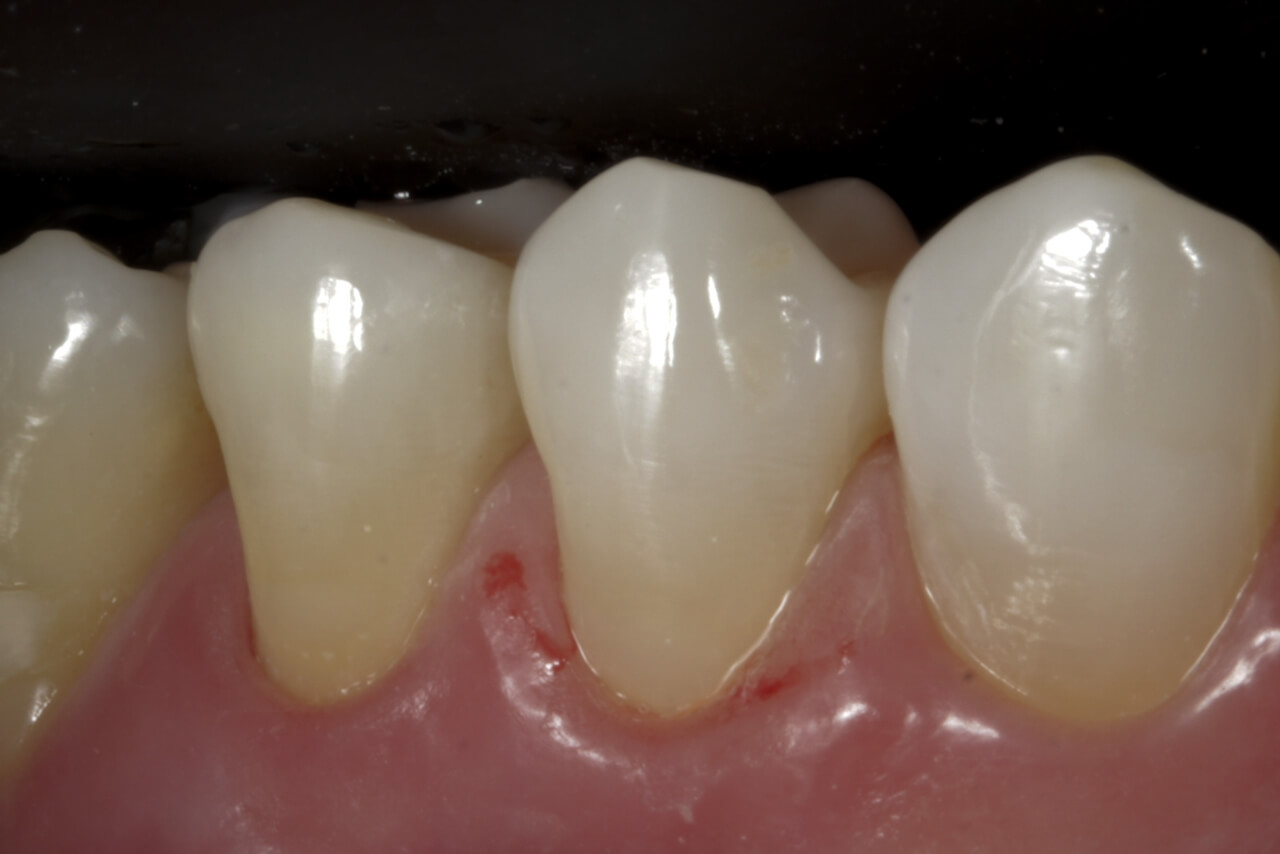 Fig. 14 Fotografía de los elementos dentales restaurados tras 7 días.