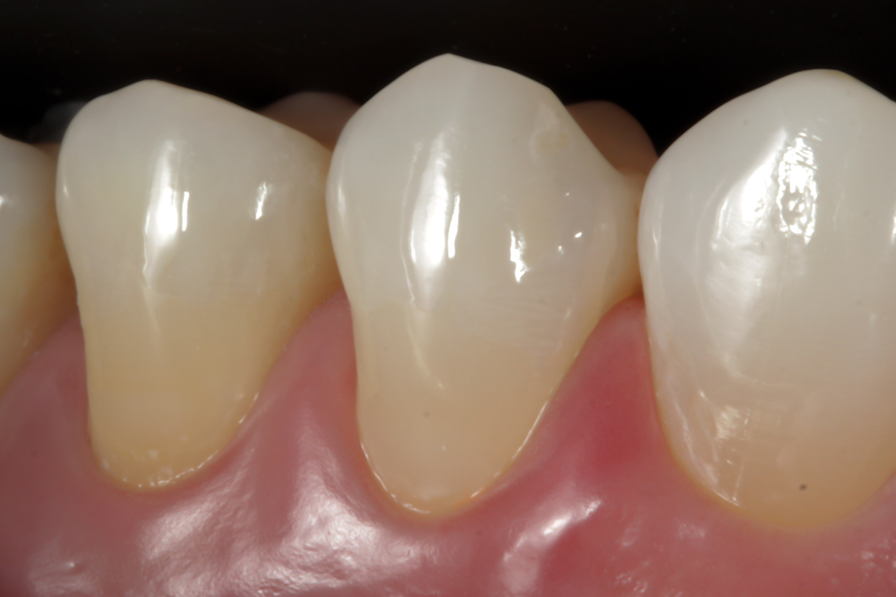 Fig. 13 Fotografía de los elementos dentales restaurados tras el acabado y pulido inicial.