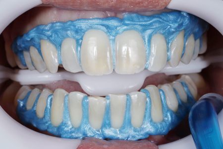 Fig. 2 – Aplicação da Barreira gengival Top Dam (FGM) em todas as papilas e contorno cervical dos dentes até 1º molar.