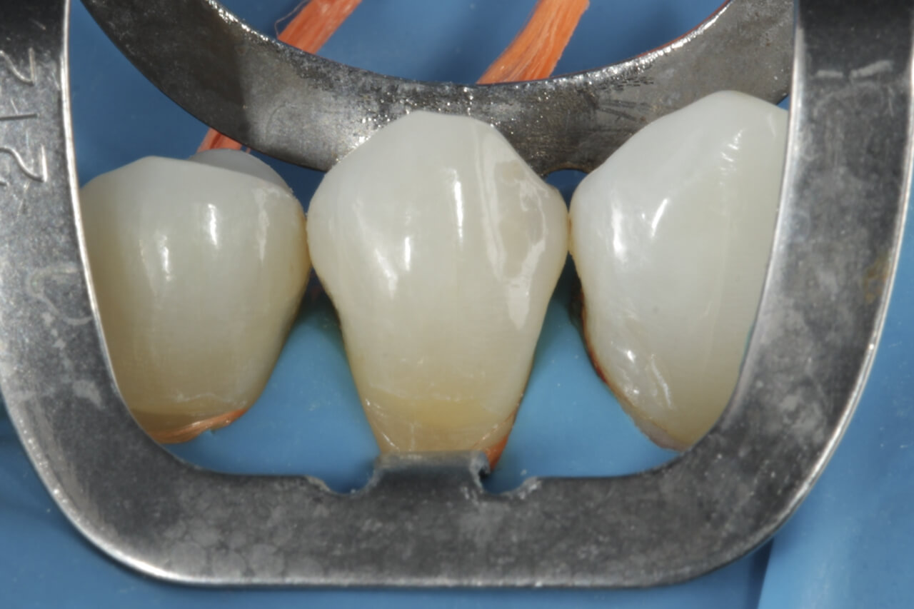 Fig. 2 Isolamento absoluto dos dentes a serem restaurados e retração gengival mecânica com um grampo 212 no elemento dental 24.