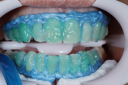 Fig. 3 – Aplicação do gel branqueador à base de peróxido de hidrogénio Whiteness HP Automixx 6% (FGM) na superfície vestibular dos dentes