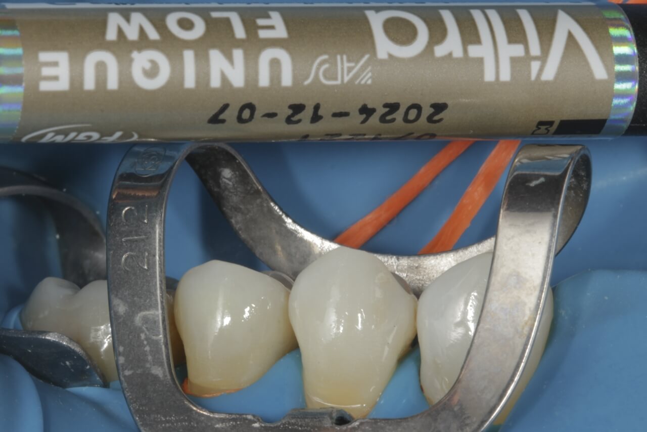Fig. 5 Resina compuesta fluida unicromática (Vittra APS Unique Flow - FGM) utilizada para restauración directa de las cavidades.