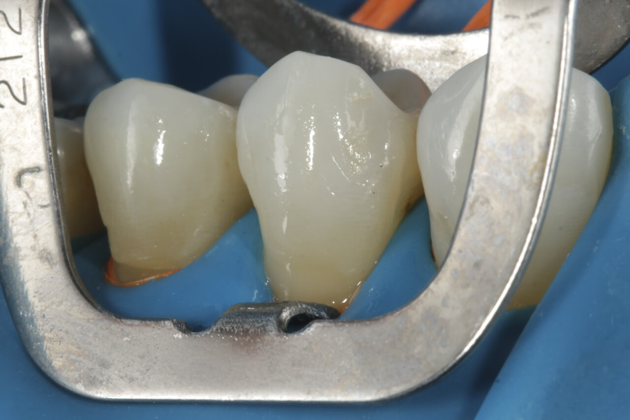 Fig. 6 Aspecto inmediato de la restauración en el diente 24.