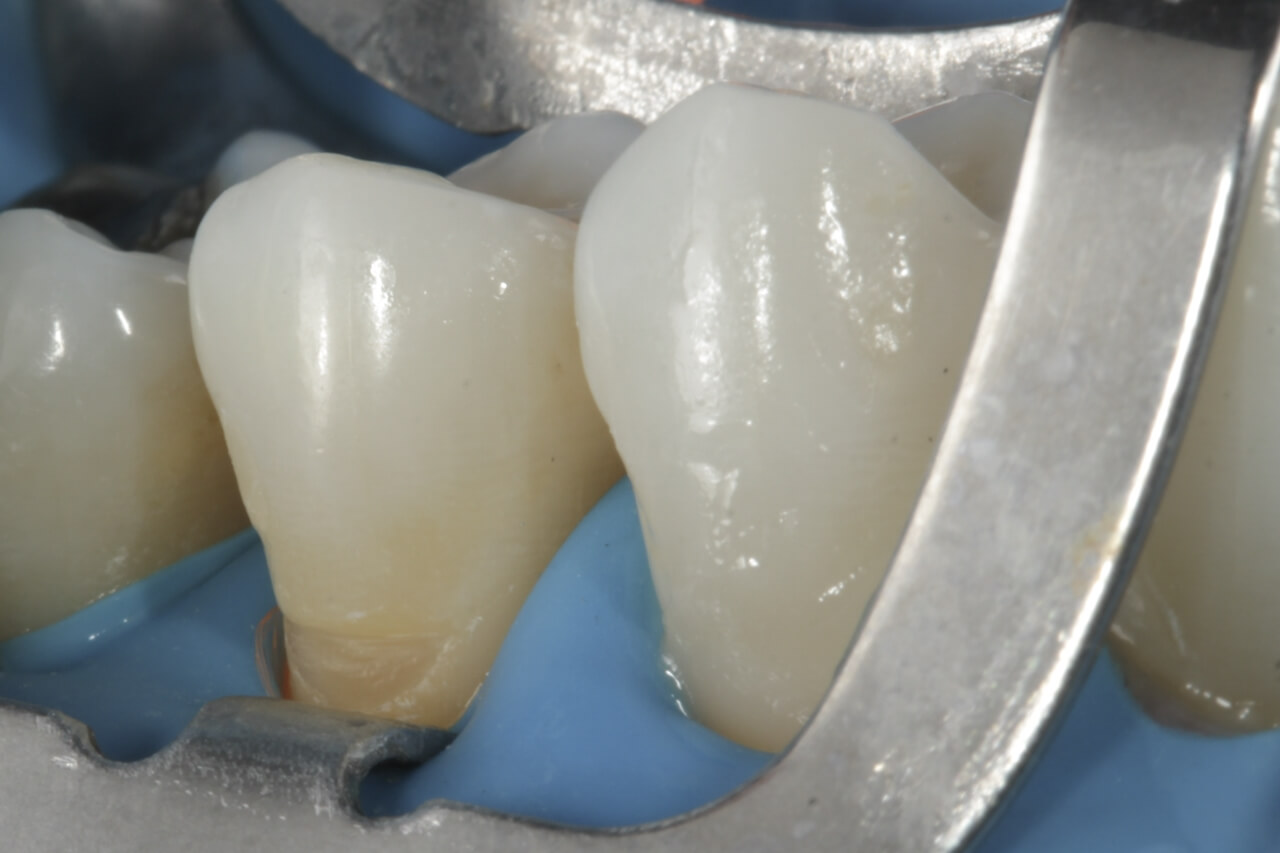 Fig. 7 Grapa 212 posicionada en el diente 25 para separación gingival mecánico y exposición de los márgenes cervicales de la cavidad.