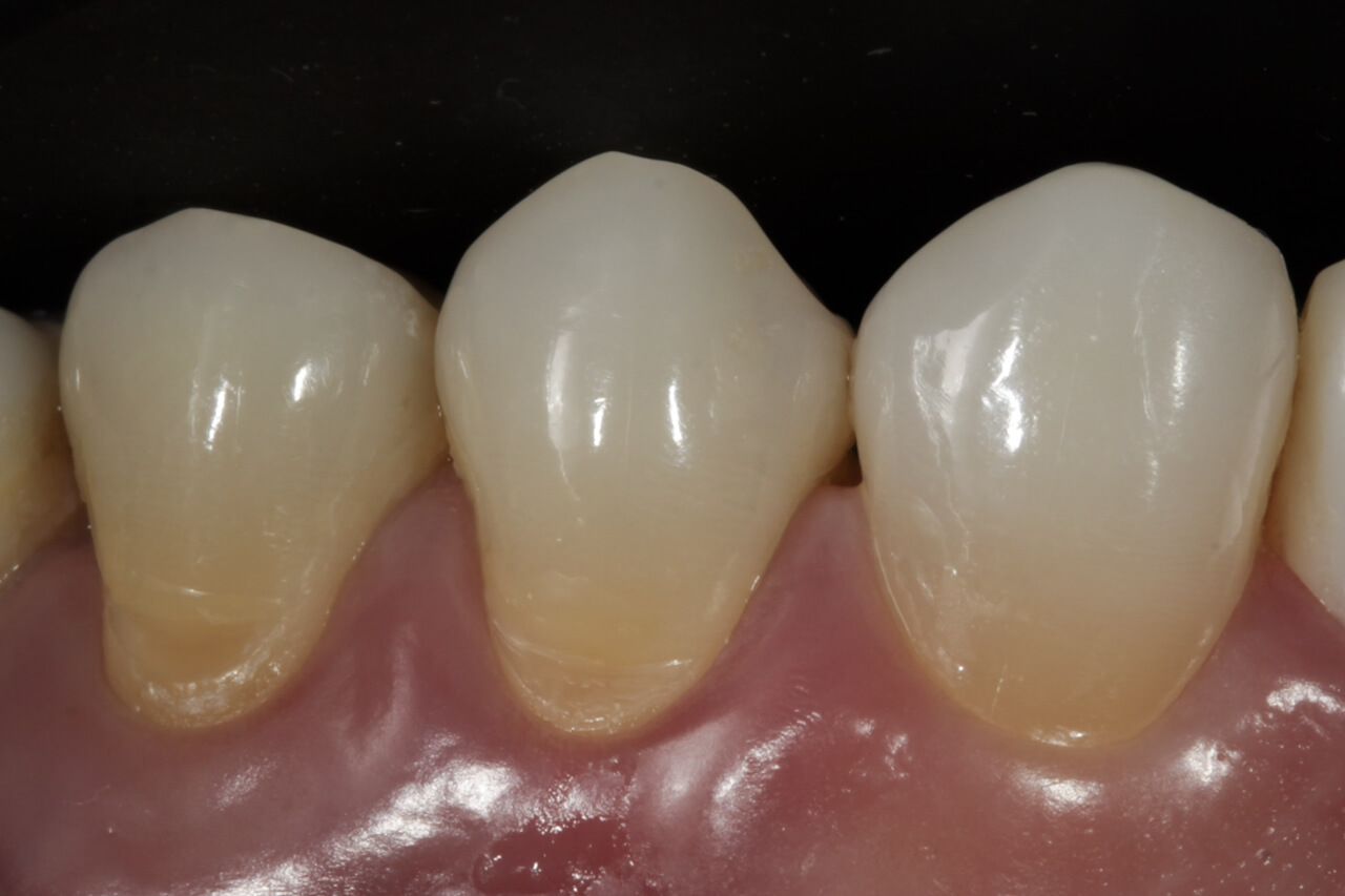 Fig.1 Aspecto inicial do caso, lesões cervicais não cariosas (LCNC) nos elementos dentais 24 e 25, com sintomatologia dolorosa ao gelado.