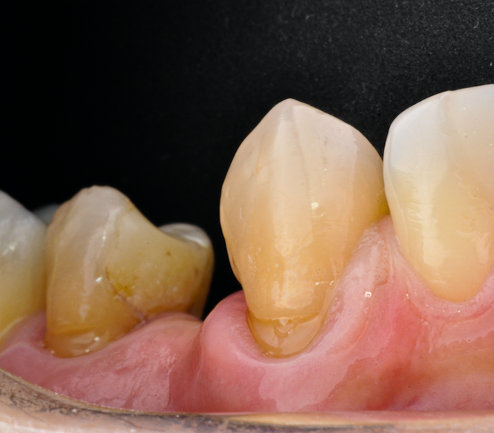 Figura 1 Aspecto Inicial do dente 23 com Lesão cervical não cariosa