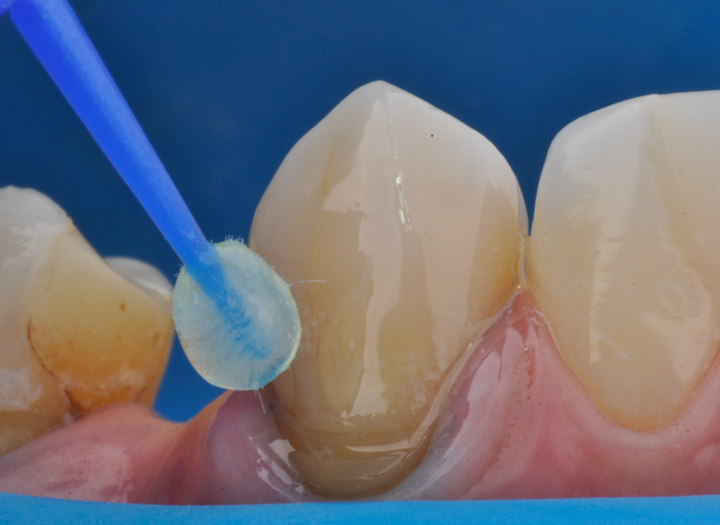 Figura 3 Aplicação do Sistema Adesivo Ambar Universal APS (FGM) em esmalte e dentin