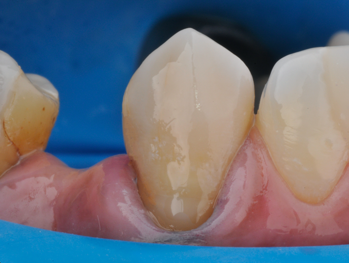 Figura 6 Aspecto do incremento após a fotoativação, mimetizando a cor do dente