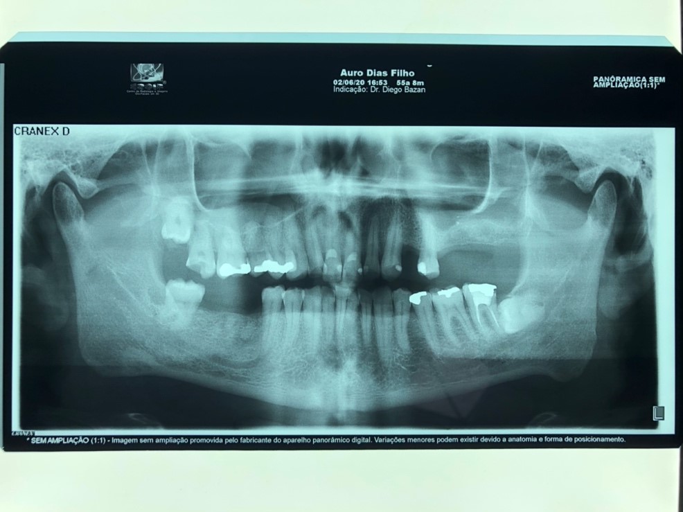 Fig. 6: Radiográfica com 12 meses de acompanhamento.