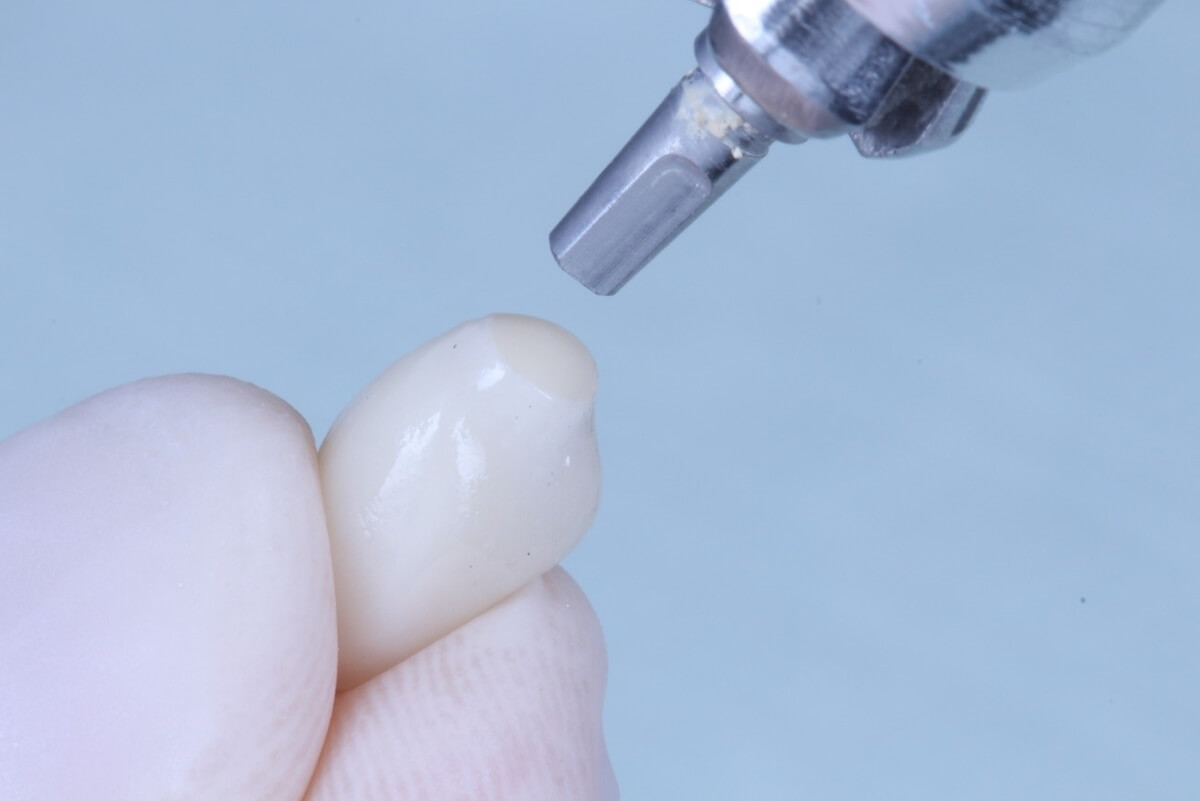011 Preenchimento com cimento resinoso antes do extravasamento do cimento 1 - Implante inmediato, practicidad clínica y confort al paciente