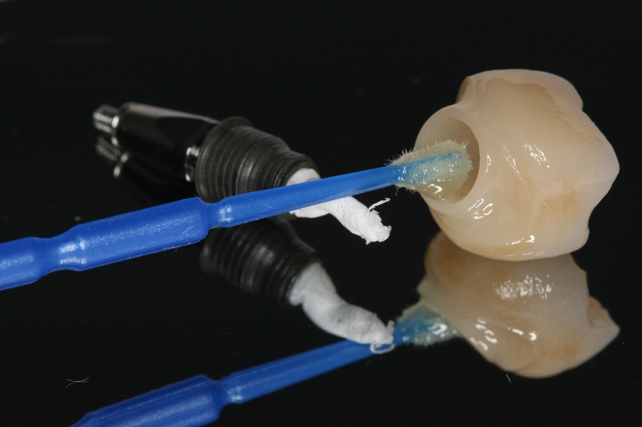 Fig 10 - New tools for rehabilitation on implants, Arcsys and digital workflow