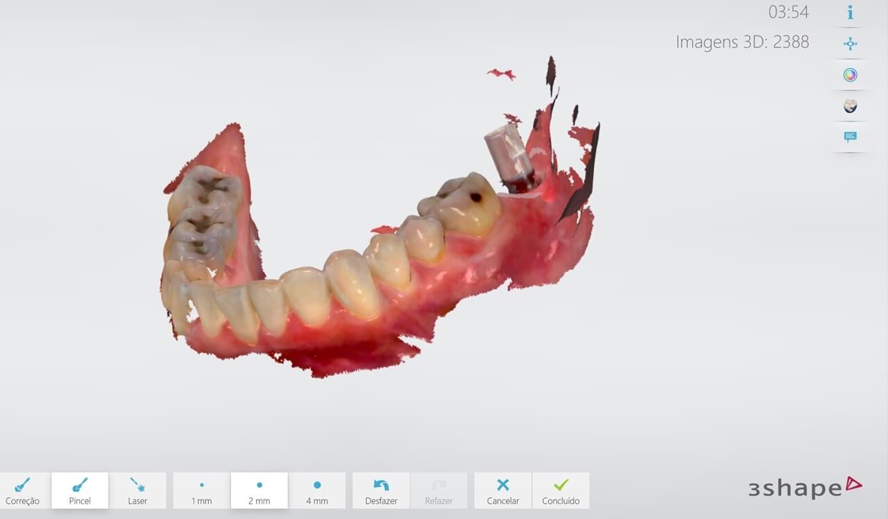 Fig 4 - New tools for rehabilitation on implants, Arcsys and digital workflow