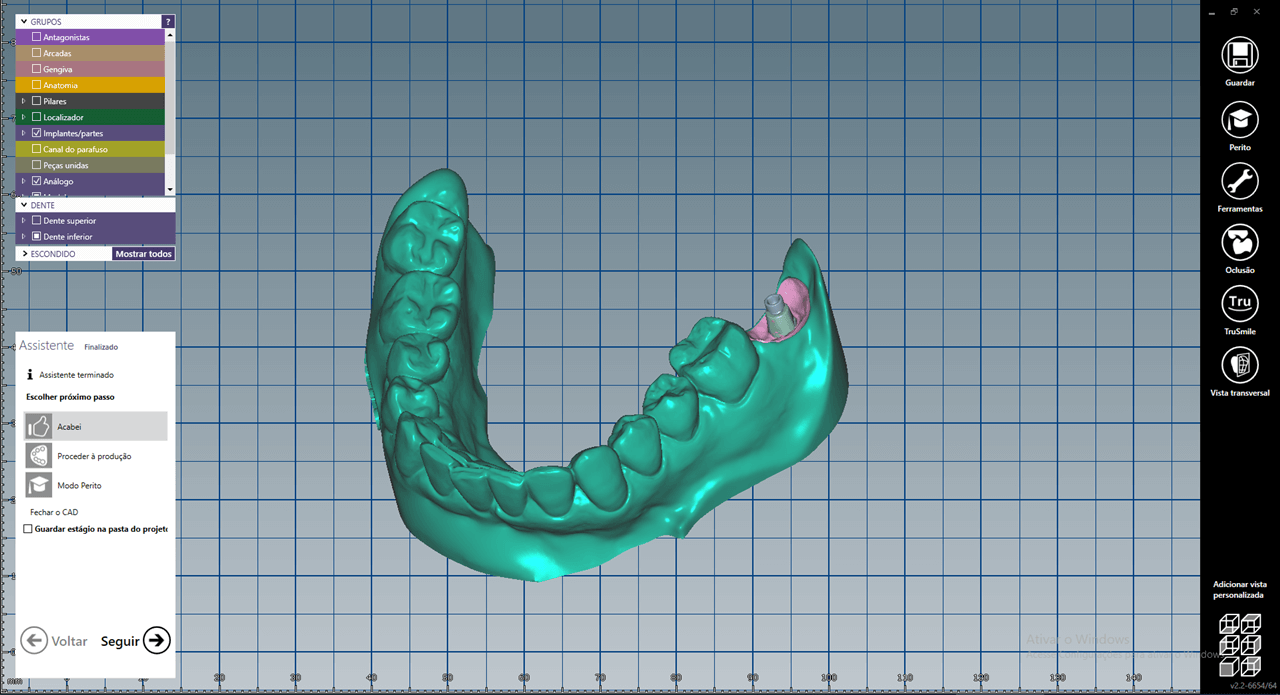 Fig 5a - New tools for rehabilitation on implants, Arcsys and digital workflow