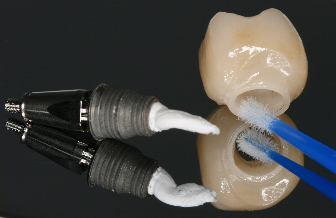 Fig 9 - New tools for rehabilitation on implants, Arcsys and digital workflow