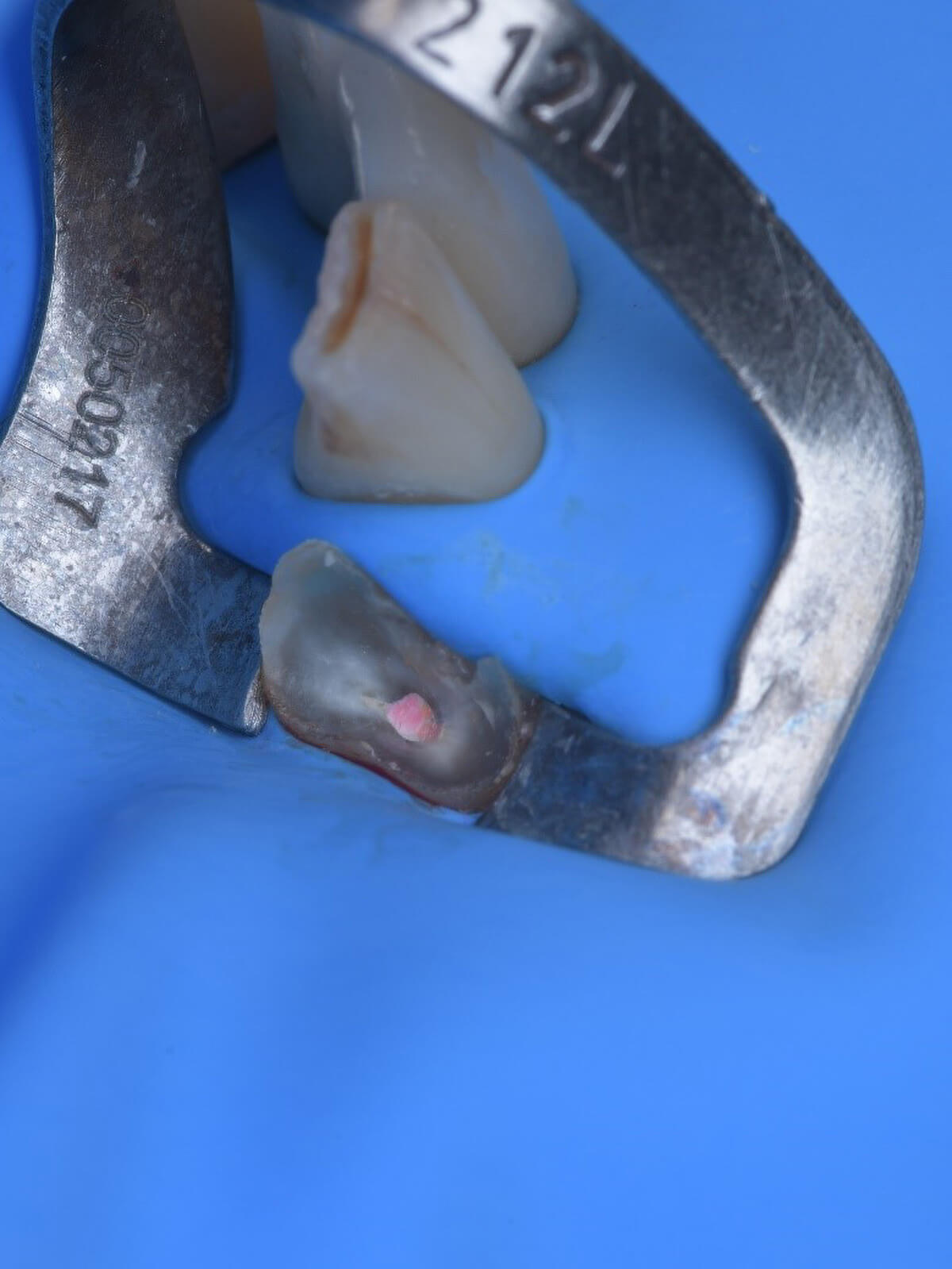 Fig. 04 Isolamento absoluto do dente 42 para iniciar os procedimentos.
