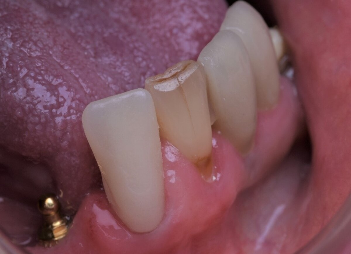 Fig. 12 Provisório em acrílico realizado com faceta de dente de estoque