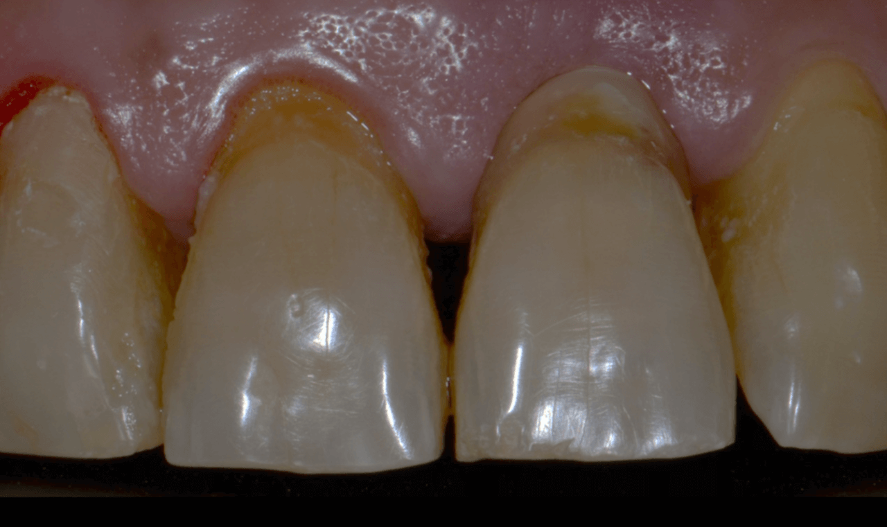 Figura 1 Exame clinico inicial - Treatment of a fracture on an upper central incisor with rehabilitation through immediate implant carried out with a virtual surgical guide: a clinical case report