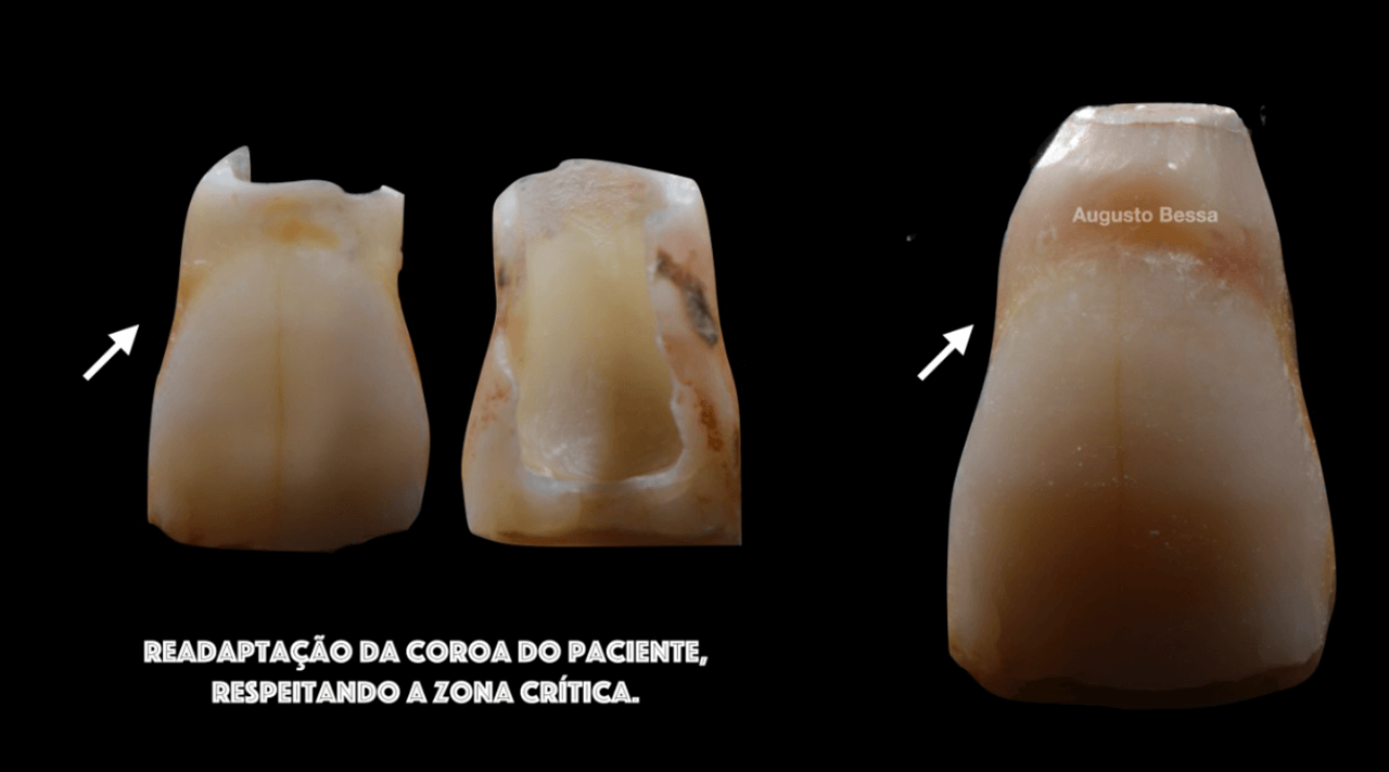 Figura 11 Provisoria confeccionada - Treatment of a fracture on an upper central incisor with rehabilitation through immediate implant carried out with a virtual surgical guide: a clinical case report