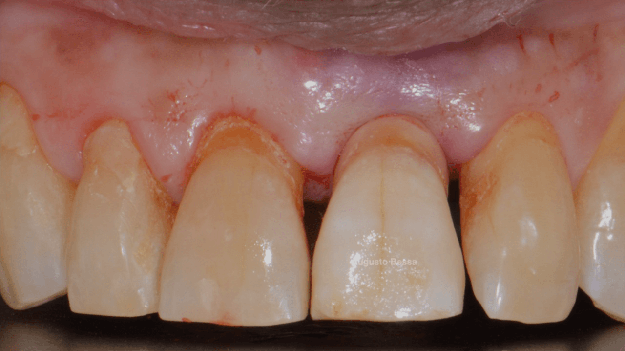Figura 12 Coroa provisoria cimentada - Treatment of a fracture on an upper central incisor with rehabilitation through immediate implant carried out with a virtual surgical guide: a clinical case report
