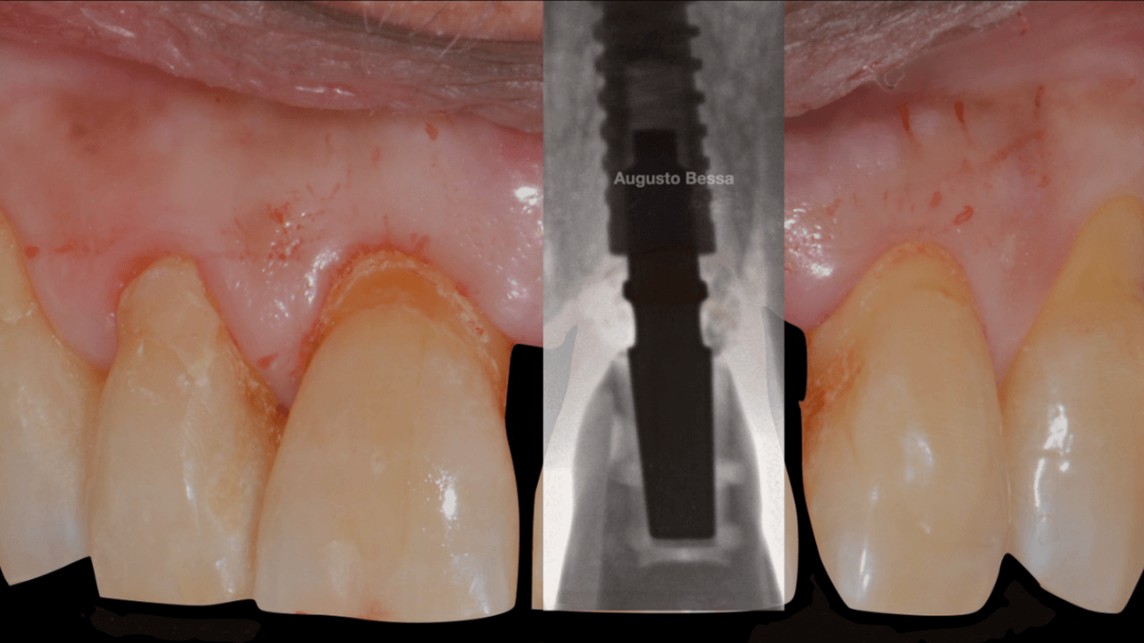 Figura 13 Implante instalado e coroa provisori - Treatment of a fracture on an upper central incisor with rehabilitation through immediate implant carried out with a virtual surgical guide: a clinical case report