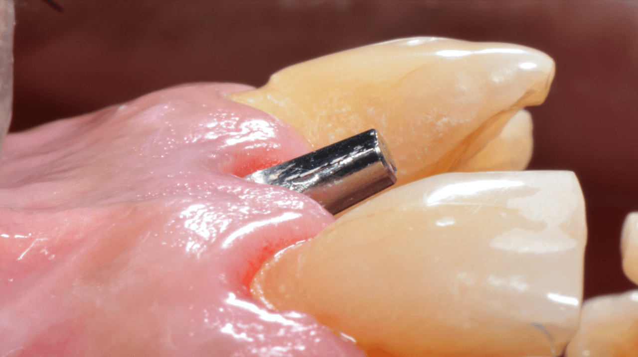 Figura 14 Estetica Periimplantar apos a cicatr - Treatment of a fracture on an upper central incisor with rehabilitation through immediate implant carried out with a virtual surgical guide: a clinical case report