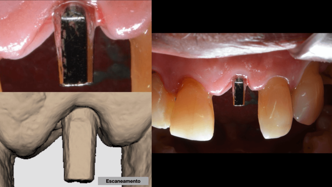 Figura 16 Escaneamento do nunhao protetico - Treatment of a fracture on an upper central incisor with rehabilitation through immediate implant carried out with a virtual surgical guide: a clinical case report