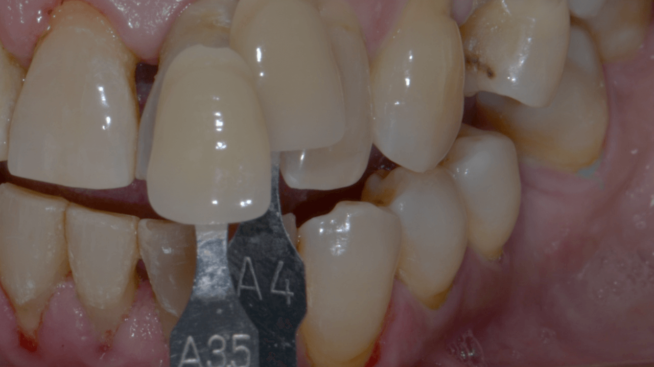Figura 17 Selecao de cores - Treatment of a fracture on an upper central incisor with rehabilitation through immediate implant carried out with a virtual surgical guide: a clinical case report