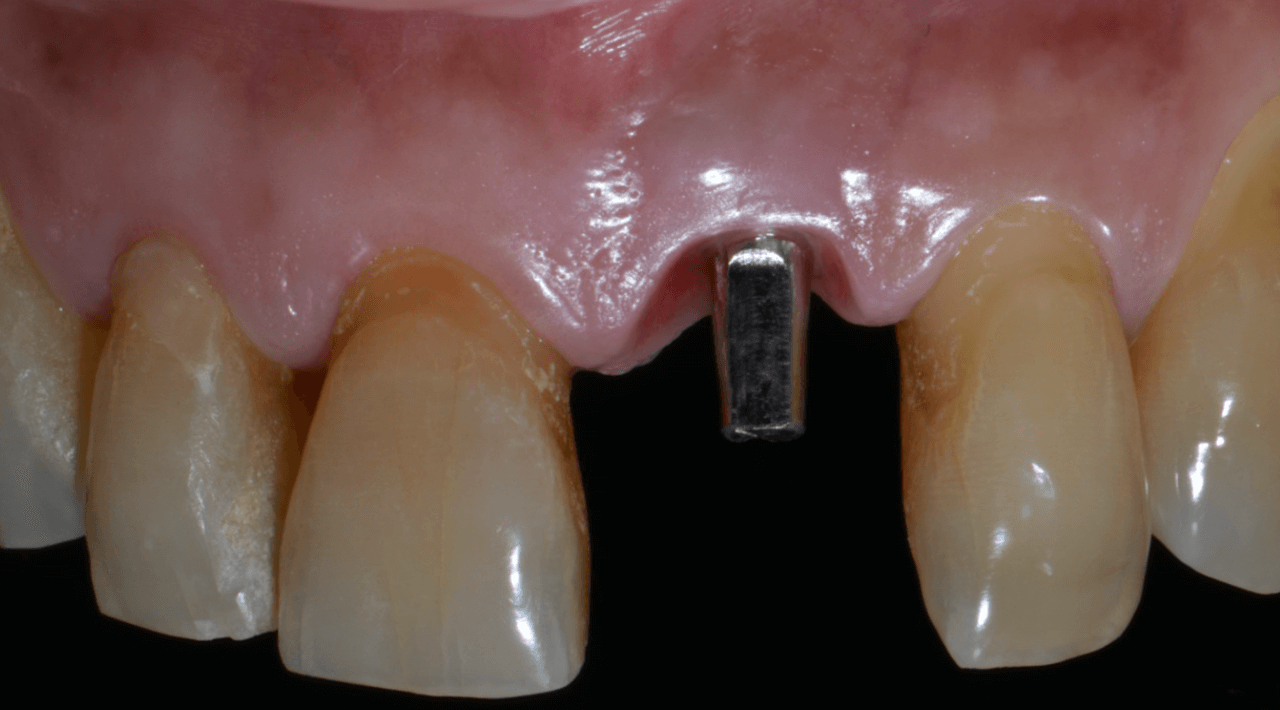 Figura 18 Perfil de emergencia - Treatment of a fracture on an upper central incisor with rehabilitation through immediate implant carried out with a virtual surgical guide: a clinical case report