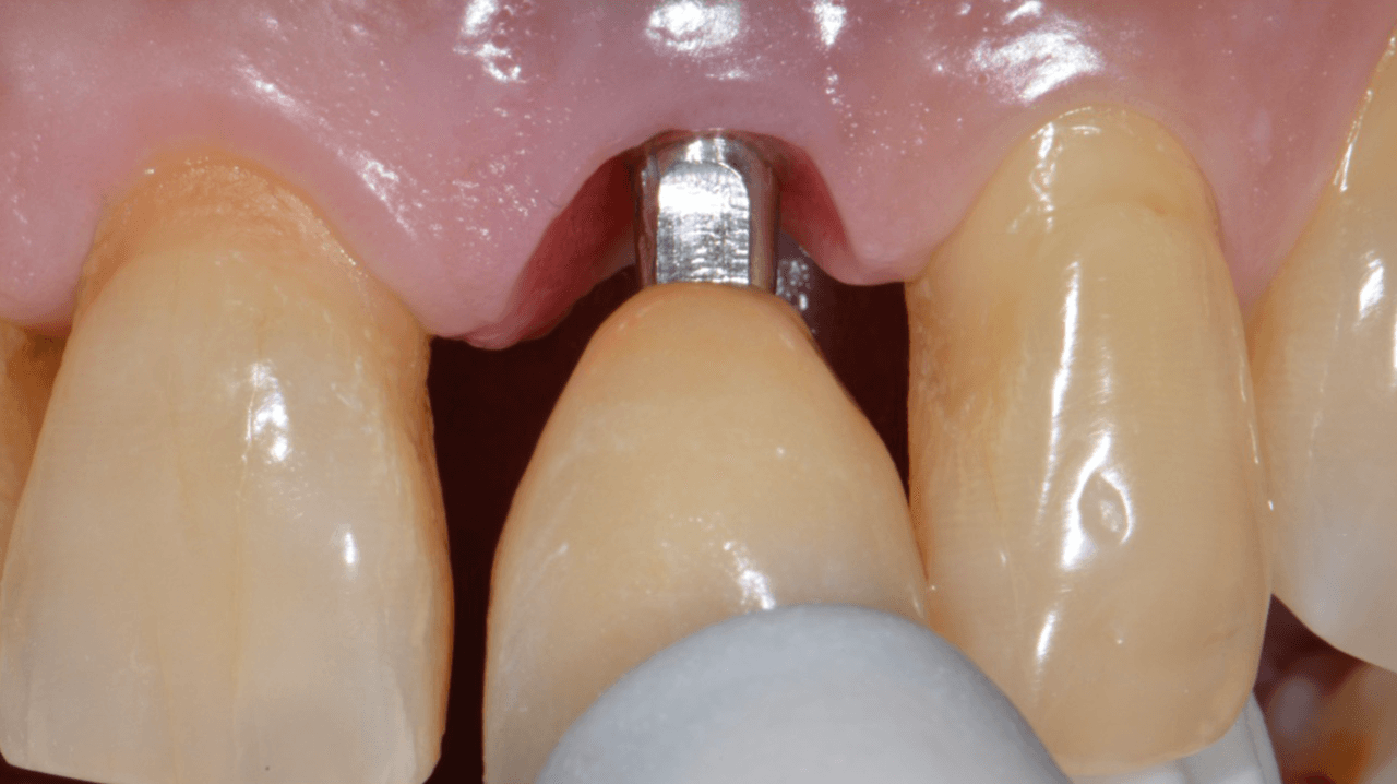 Figura 19 Prova da coroa definitiva. Observa s - Treatment of a fracture on an upper central incisor with rehabilitation through immediate implant carried out with a virtual surgical guide: a clinical case report