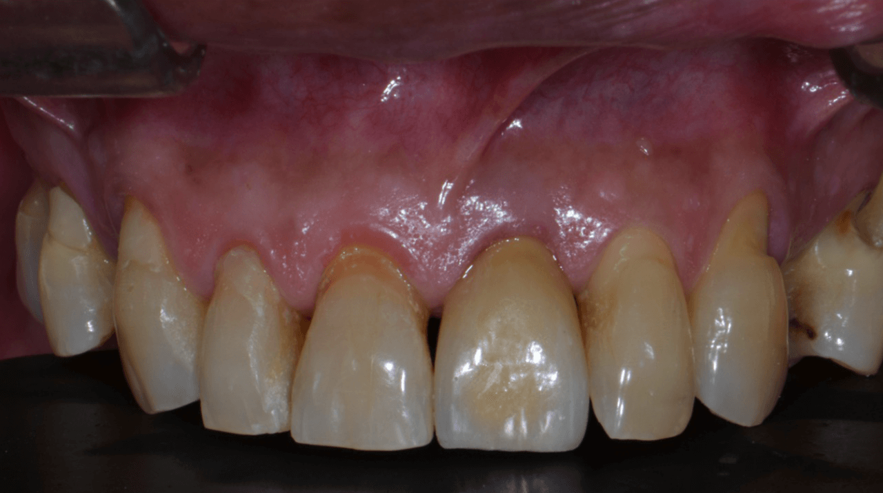 Figura 20 Cimentacao final - Treatment of a fracture on an upper central incisor with rehabilitation through immediate implant carried out with a virtual surgical guide: a clinical case report