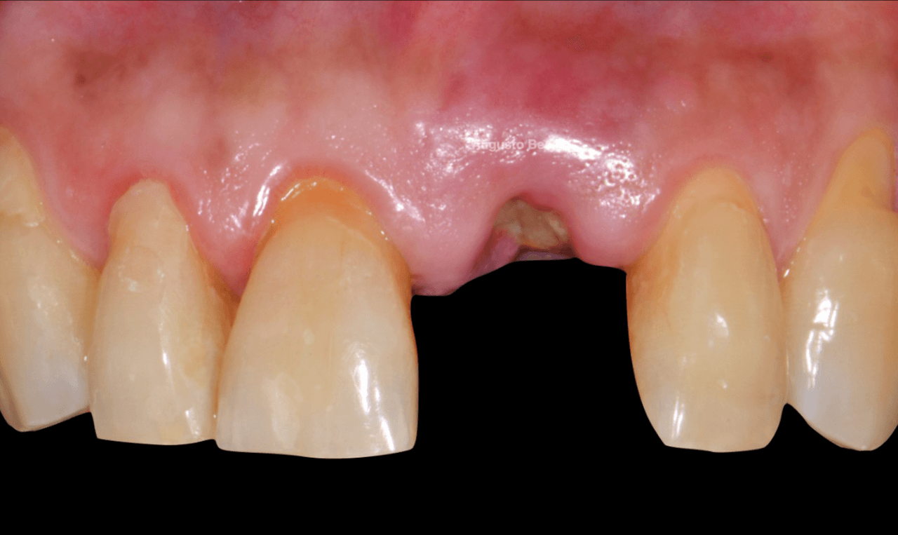Figura 3 Remocao da coroa fragmentada - Treatment of a fracture on an upper central incisor with rehabilitation through immediate implant carried out with a virtual surgical guide: a clinical case report