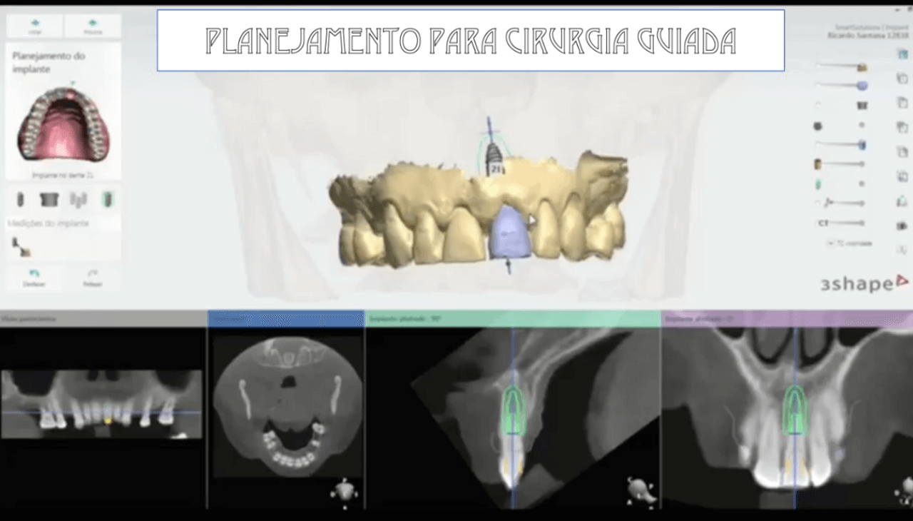 Figura 5 Planejamento para guia cirurgico 3Sha - Treatment of a fracture on an upper central incisor with rehabilitation through immediate implant carried out with a virtual surgical guide: a clinical case report
