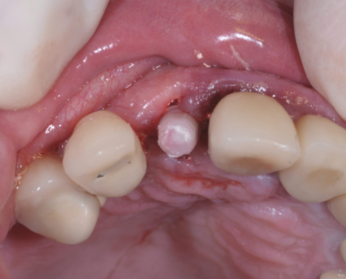 - Tips for Making Provisional Restorations on Implants