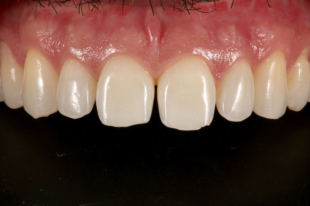 Fig. 2 Apos clareamento dental caseiro com Whiteness Perfect 10 FGM. - Allcem Veneer APS na confecção de laminados minimamente invasivos