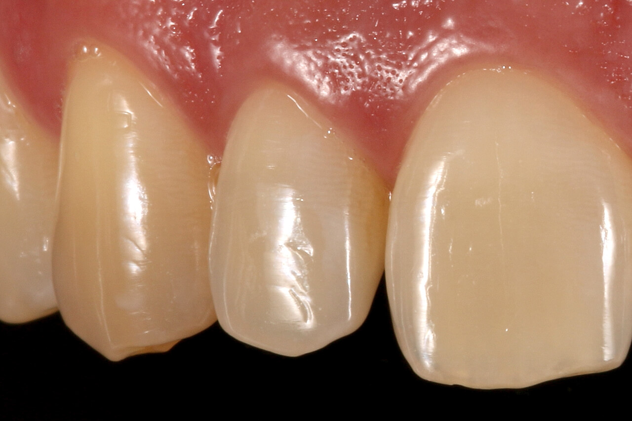Figs. 1a e 1b Vista aproximada frontal A e lateral B dos dentes anteriores apresentando desgaste. 2 - Allcem Veneer APS na confecção de laminados minimamente invasivos