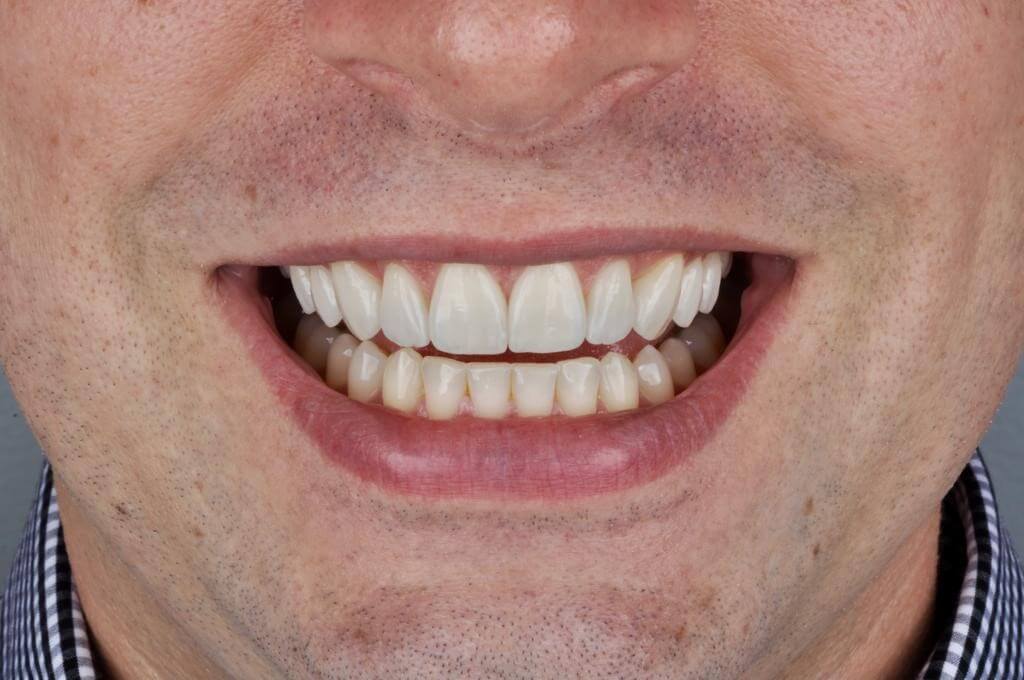 Figura 16 - ARTIGO: Dicas de Clareamento Dental e Laminados Cerâmicos