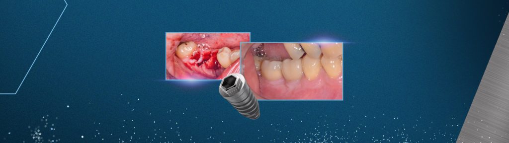 Manutencao ossea alveolar com Nanosynt e implantes dentarios hexagono externo VEZZA - Manutenção óssea alveolar com Nanosynt e implantes dentários hexágono externo Vezza HE