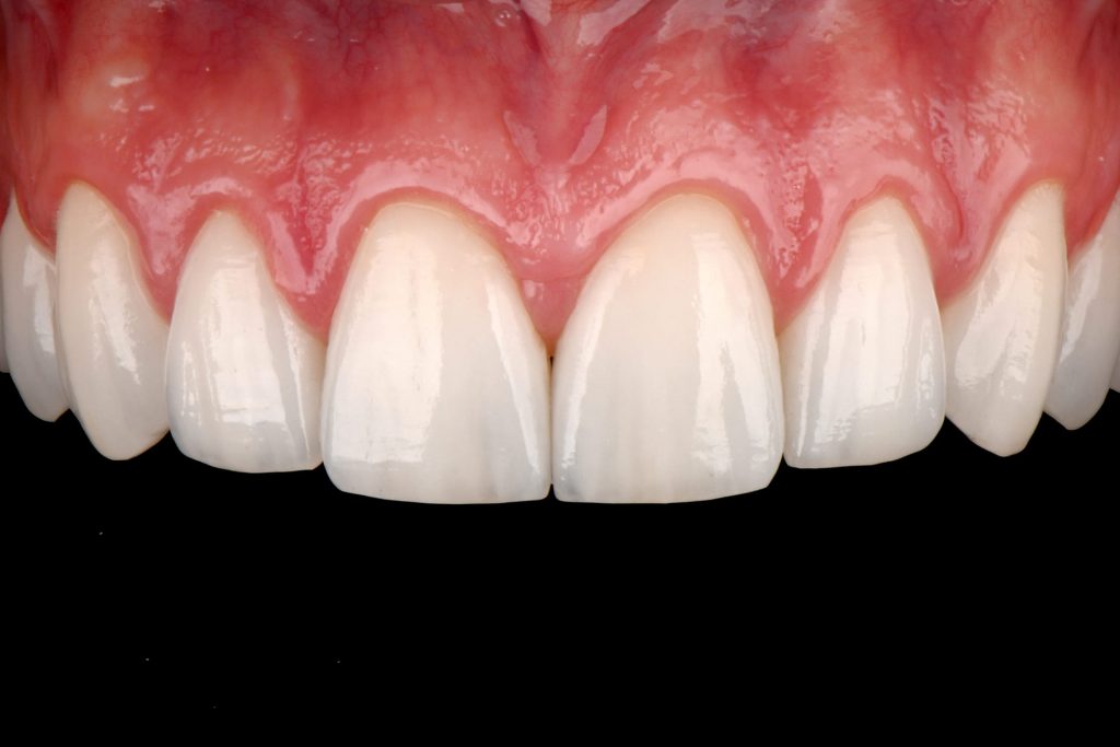 10A1 - Restabelecimento do corredor bucal e do sorriso com cirurgia plástica periodontal e laminados cerâmicos