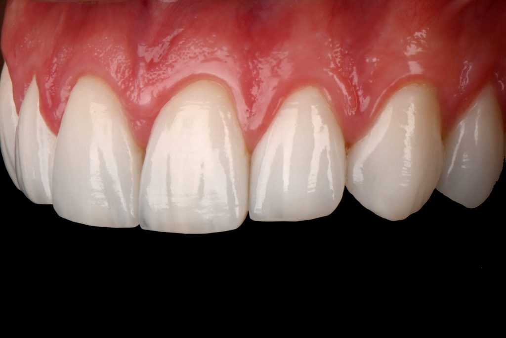 10B1 - Restabelecimento do corredor bucal e do sorriso com cirurgia plástica periodontal e laminados cerâmicos