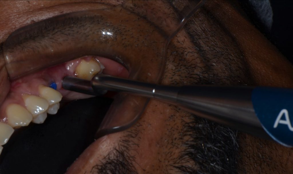 11 11 - Levantamento de seio maxilar com instalação concomitante de Implantes: relato de caso clínico