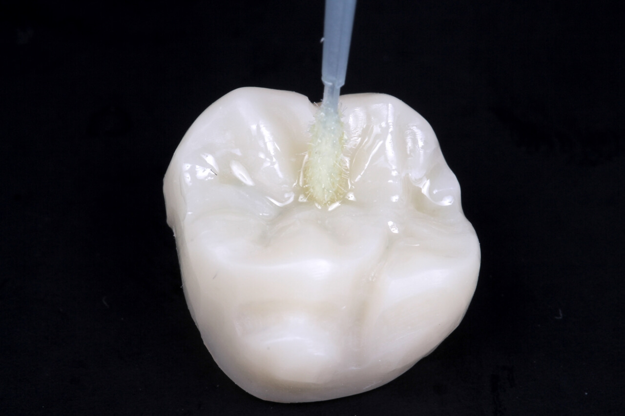 11 Para receber a peça, deve-se fazer o preparo adesivo no dente, que compreende o condicionamento ácido de esmalte e dentina e a aplicação de adesivo. No caso de uso de adesivo autocondicionante, o condicionamento ácido é dispensável.