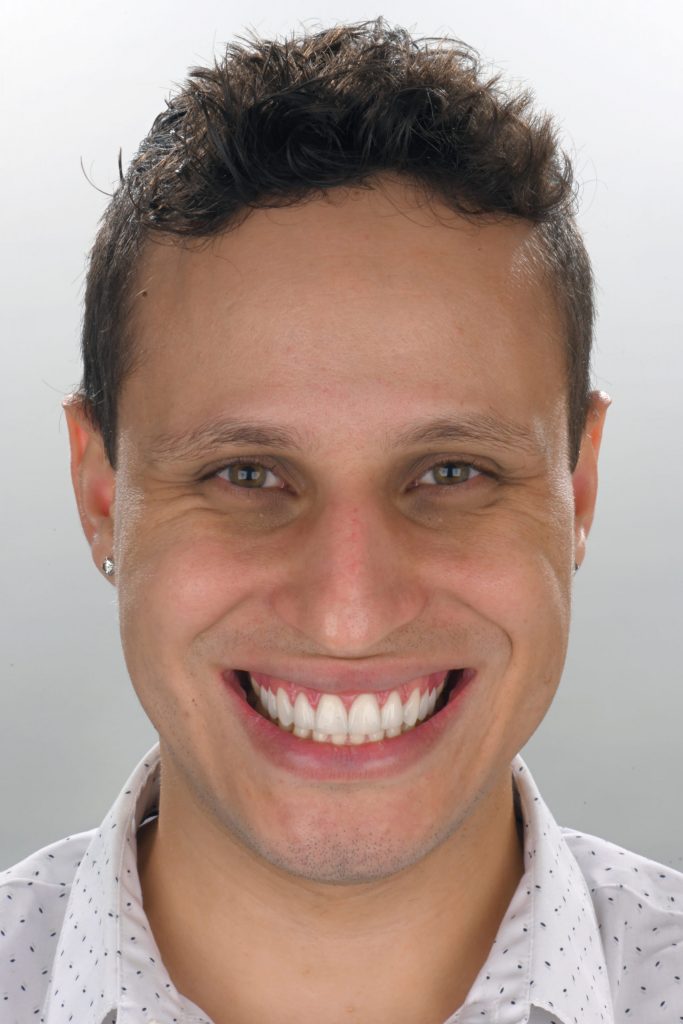 11A scaled1 - Restabelecimento do corredor bucal e do sorriso com cirurgia plástica periodontal e laminados cerâmicos