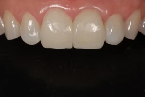 Dental Cements, Allcem Core, VENEER APS