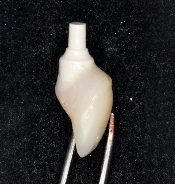 181 - Implante imediato com carga imediata sobre cicatrizador personalizando área peri-implantar
