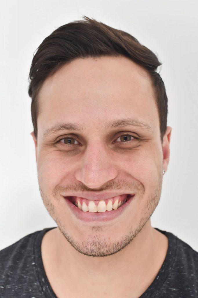 1A scaled1 - Restabelecimento do corredor bucal e do sorriso com cirurgia plástica periodontal e laminados cerâmicos